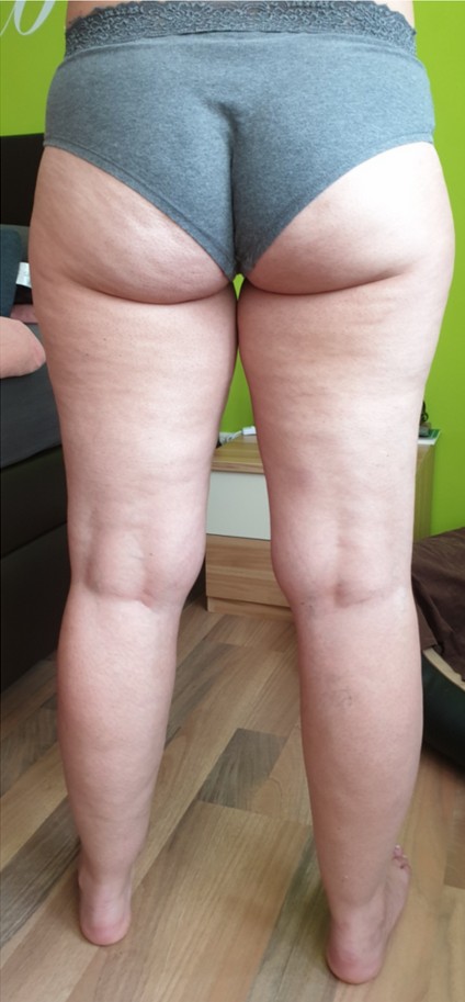 Lipödem Beine vorher – Ernährungsberatung Nürnberg