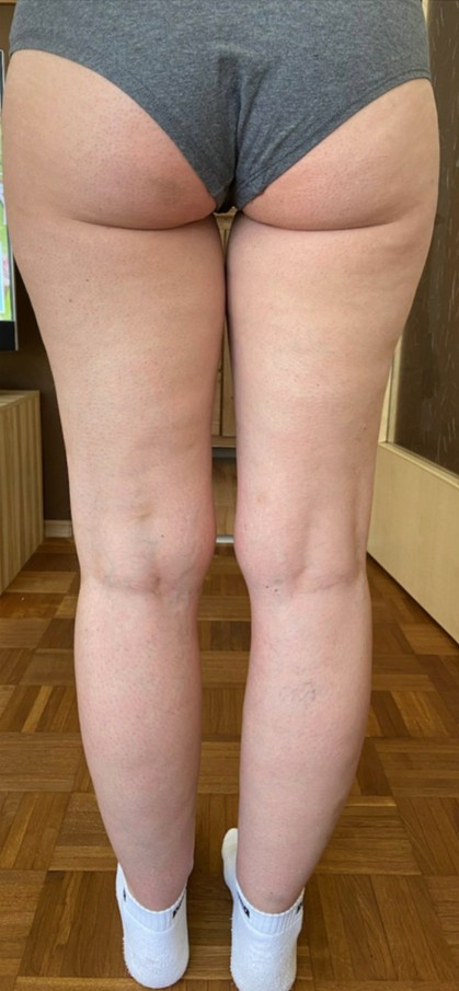 Lipödem Beine nachher – Ernährungsberatung Nürnberg